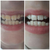 سفید کننده دندان گلوری اسمایل
